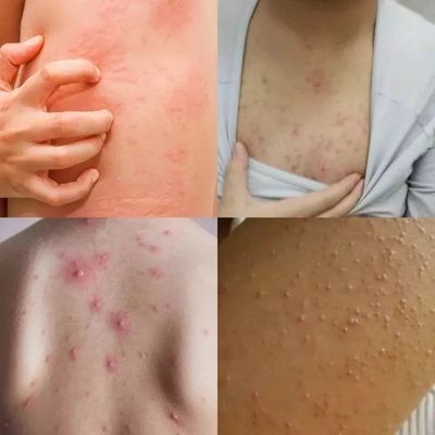 10秒搓出深层螨虫!痘痘、黑头没了,比10个搓澡大妈还猛!