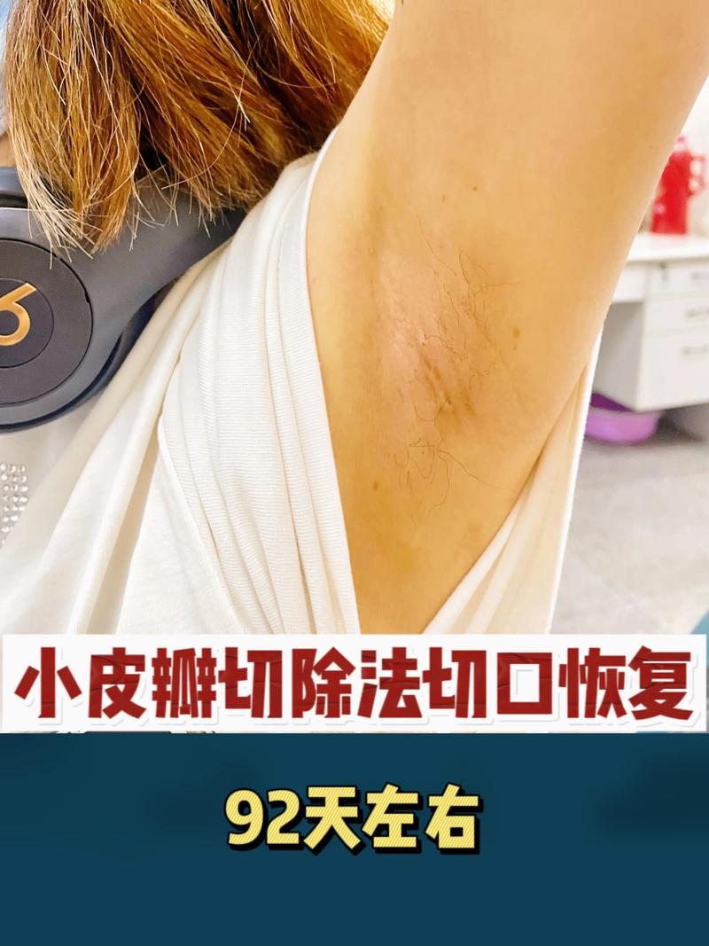 腋臭手术失败,咋回事?八,腋臭手术残留的根本原因:患者在预