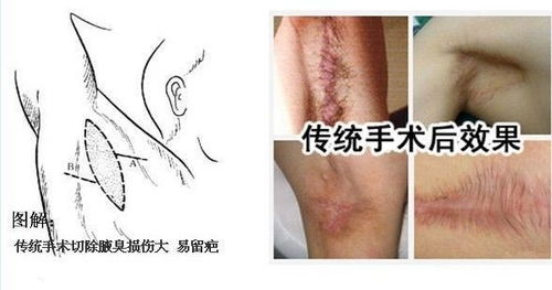 腋臭 狐臭 都有哪些治疗方法