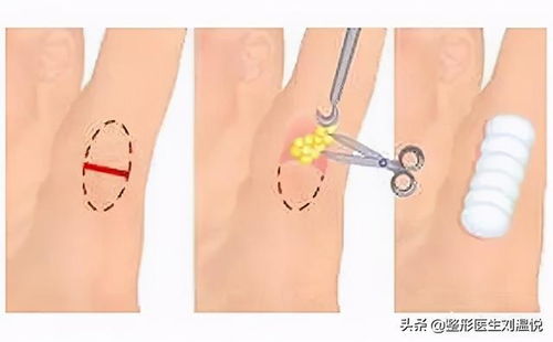 社交杀手腋臭 狐臭 的有趣冷知识和靠谱治疗小贴士